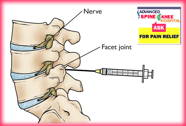 facet joint injection